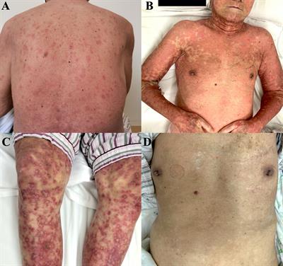 Case Report: Toxic epidermal necrolysis associated with sintilimab in a patient with relapsed thymic carcinoma